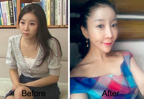 Won Jayhun before & after