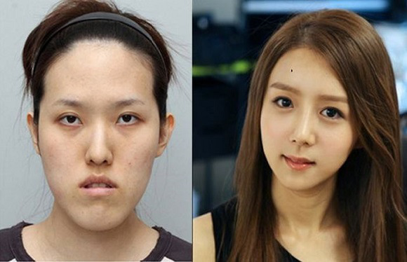 korean before & after 14