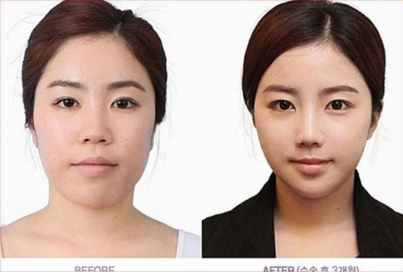 korean before & after 16