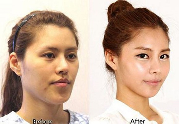 korean before & after 17