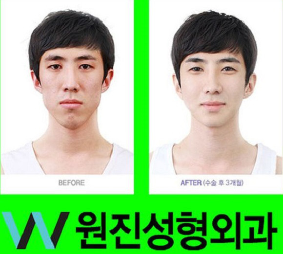 korean before & after 22