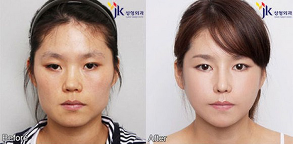 korean before & after 24