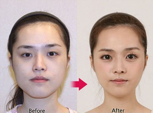 korean before & after 26