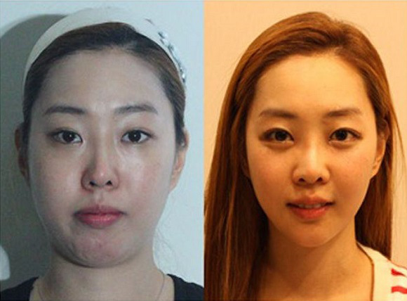 korean before & after 29