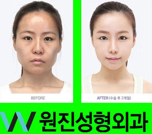 korean before & after 32