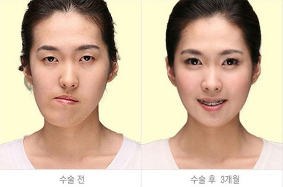 korean before & after 33