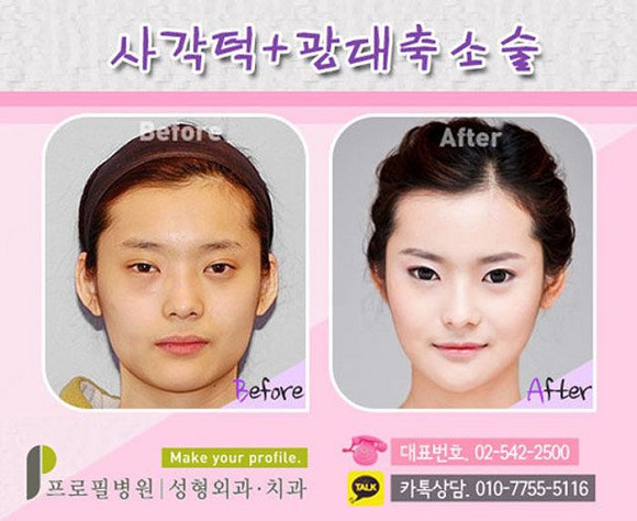 korean before & after 34