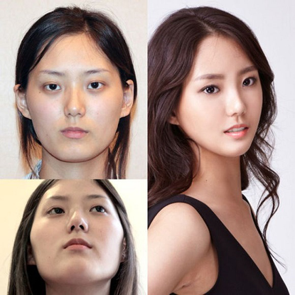 korean before & after 35