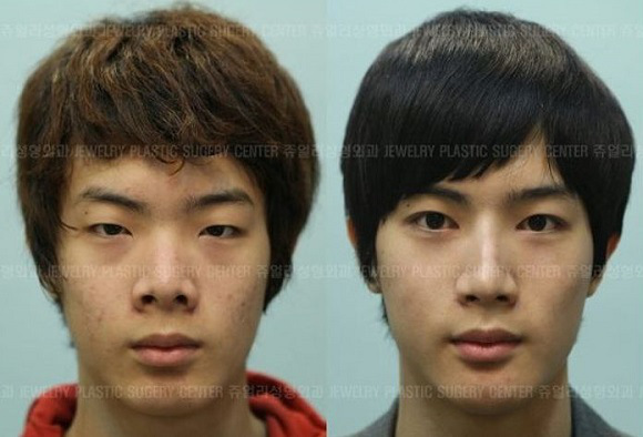 korean before & after 36