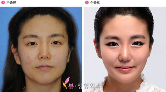 korean before & after 40