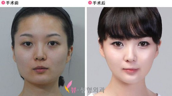 korean before & after 45