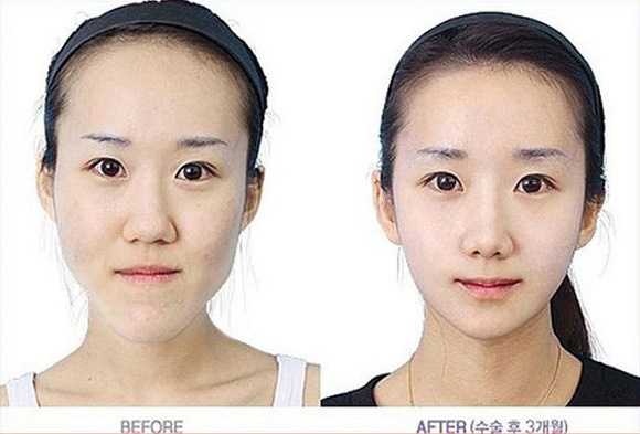 korean before & after 46