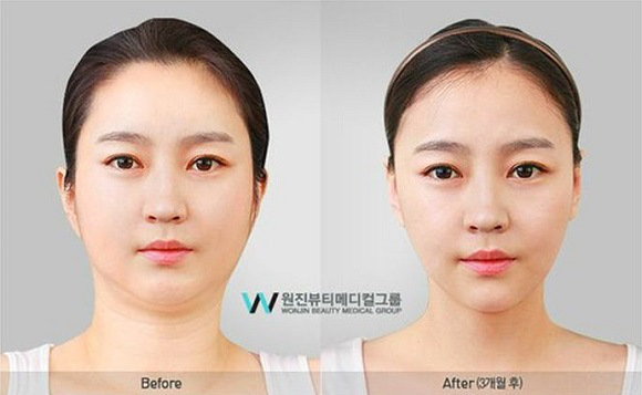 korean before & after 47