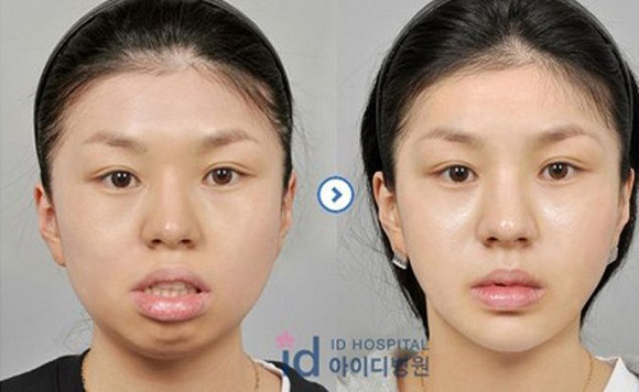 korean before & after 48