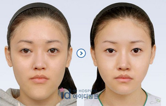 korean before & after 49