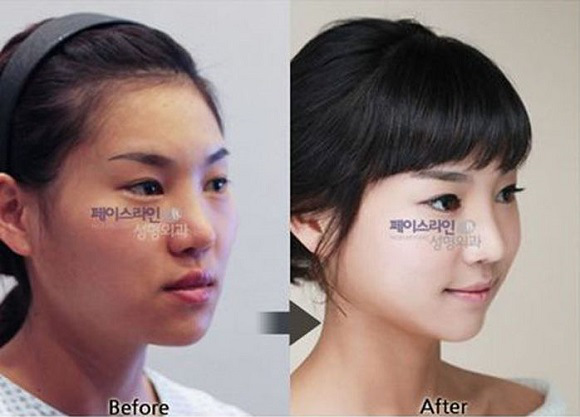 korean before & after 52