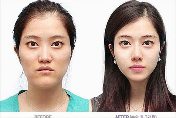 korean before & after 53