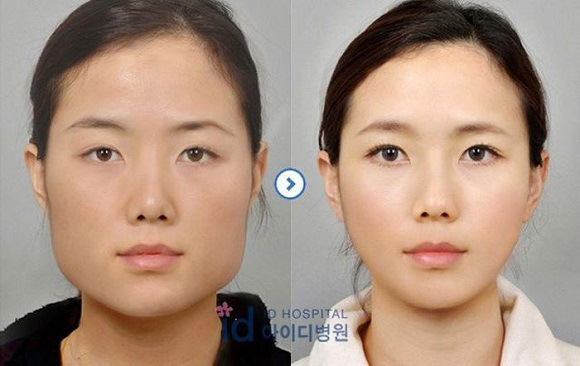 korean before & after 54