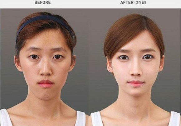 korean before & after 55