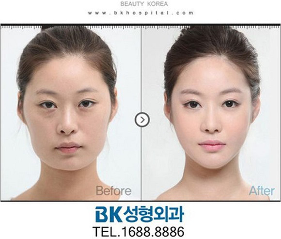 korean before & after 56