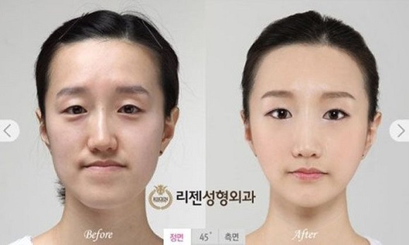 korean before & after 58