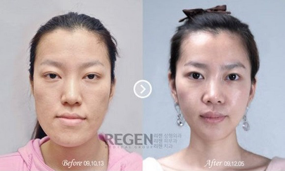 korean before & after 59